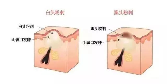 如何有效改善閉口粉刺？改善閉口粉刺的方法！