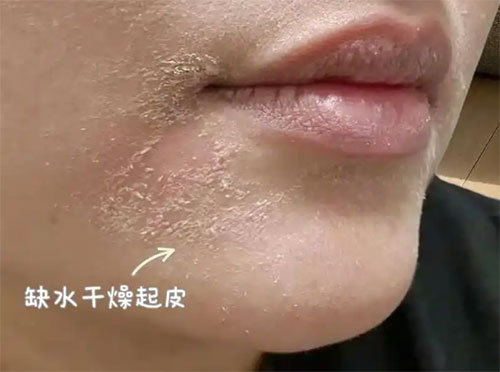 臉部脫皮干燥脫屑是怎么回事？